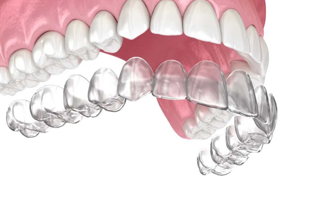adobestock Contention Dr Déborah Fellous | Orthodontiste à Charenton-le-Pont