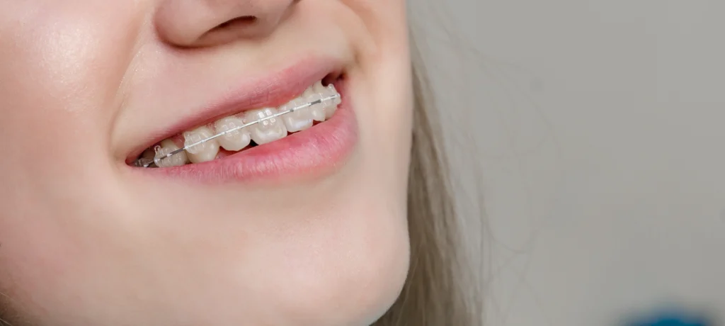 adobestock Orthodontie de l’adolescent Dr Déborah Fellous | Orthodontiste à Charenton-le-Pont