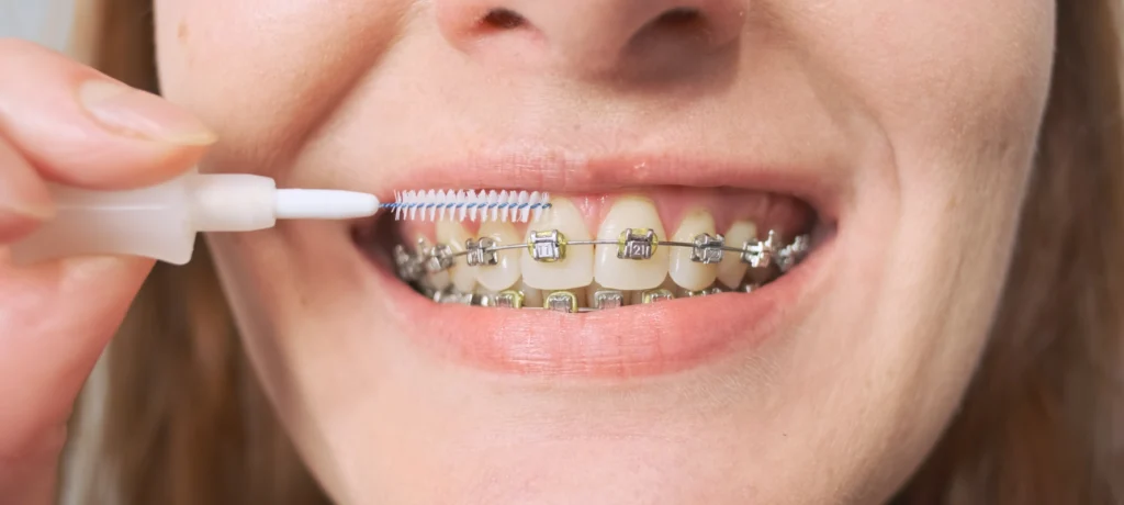 adobestock Orthodontie de l’adolescent Dr Déborah Fellous | Orthodontiste à Charenton-le-Pont