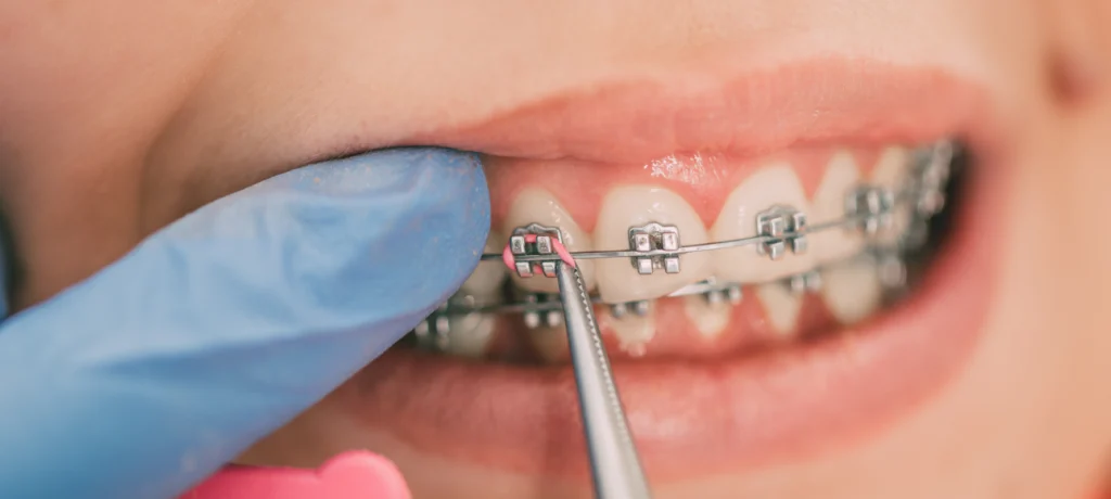 adobestock adobestock Port d'élastiques inter-arcades Dr Déborah Fellous | Orthodontiste à Charenton-le-Pont