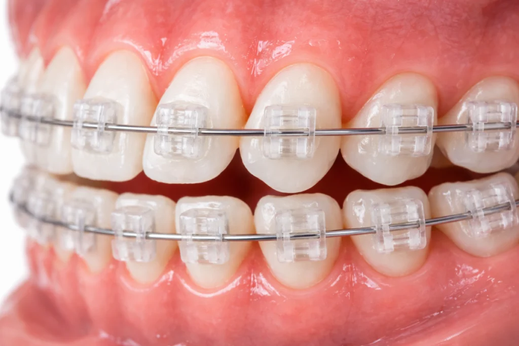 bagues autoligaturant ceramique Orthodontie de l'adulte Dr Déborah Fellous | Orthodontiste à Charenton-le-Pont